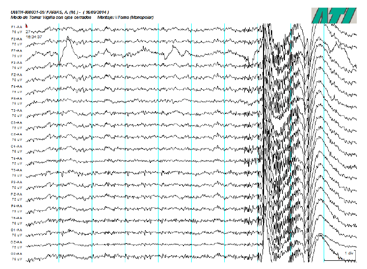 Readout of part of the EEG plot during apparent PK. Ariel was still, with eyes closed, hands on the table, and hyperventilating. A big electric perturbation is observed at the end of the plot, while the scale under the table leg indicated a weight reducti