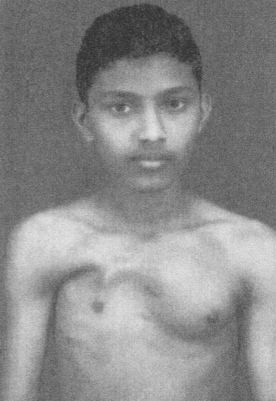 Wijeratne’s missing right pectoral muscle as it appeared at age eighteen.