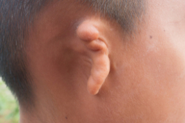 photograph of child with missing ear