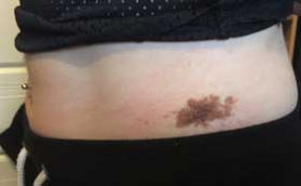 photograph of birthmark in the waist region