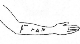Illustration of telepathic 'skin-writing' by Olga Kahl. In this example, the word Francois', thought but not spoken by a person present, was followed by the letters F R A N appearing as red marks on Kahl's forearm.