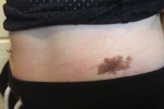 photograph of birthmark in the waist region