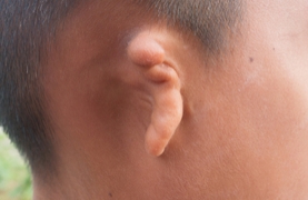 photograph of child with missing ear