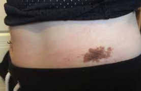 photograph of birthmark in the waist region